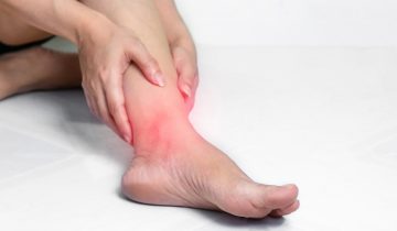 Ketika Pembengkakan Kaki Bukan Sekedar Masalah Kecil: Mengenal Varises, Jantung, dan Lebih Dalam Tentang Pembuluh Darah
