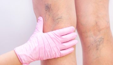 Apa Itu “Spider Veins”? Mengungkap Fakta di Balik Garis-Garis Halus di Kaki Anda