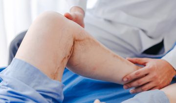 Perbedaan Varises dan Deep Vein Thrombosis (DVT)