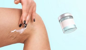 Krim Khusus Varises: Benarkah Bisa Menghilangkan?
