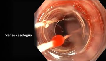 Varises Esofagus: Lebih Serius dari Varises Kaki?