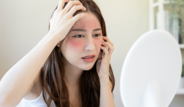 Rosacea: Penyebab, Gejala, dan Solusi Perawatan di Jakarta Varises Clinic