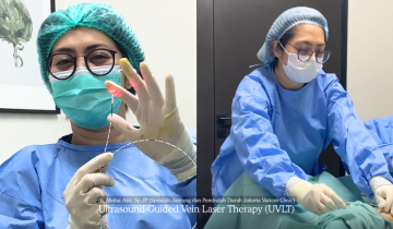 Perawatan Varises Terbaik di Jakarta: Mengapa Dokter Kini Memilih Terapi Laser Minim Invasif (UVLT)?