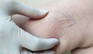 Hubungan Varises dan Kerusakan Kulit: Waspadai Tanda Ini!
