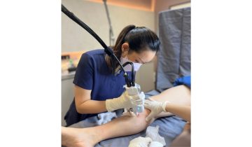 Cryolaser & Sclerotherapy: Mengenal Dua Pendekatan Minim Invasif untuk Menangani Varises 