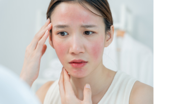 Olahraga Aman untuk Rosacea: Tetap Aktif Tanpa Memicu Kemerahan