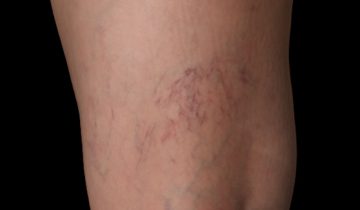 JVC Hadir Sebagai Pionir Cryo Micro Sclerotherapy: Teknologi Modern untuk Hapus Spider Vein