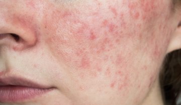 Rosacea Bukan Sekadar Kemerahan: Apa Hubungannya dengan Pembuluh Darah?