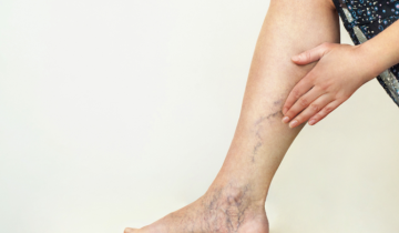 Telangiektasis dan Reticular Vein pada Perempuan: Penyebab, Risiko, dan Cara Penanganannya