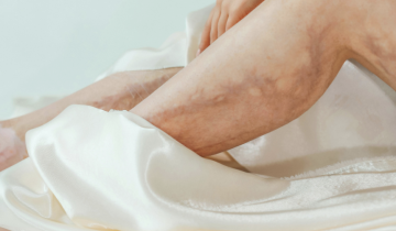 Menopause dan Varises: Perubahan yang Sering Tidak Disadari