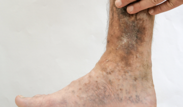 Luka di Kaki yang Tak Kunjung Sembuh? Kenali Venous Ulcer dan Hubungannya dengan Varises