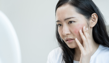Benarkah Tekanan Emosional Memicu Kemerahan pada Rosacea?