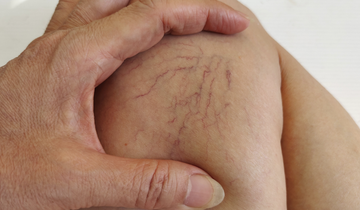 Sudah Menjalani Treatment Varises Tapi Muncul Kembali 