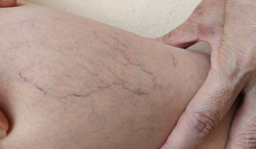 Apakah Spider Vein Makin Parah Seiring Bertambahnya Usia?